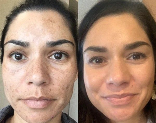 Before After Results