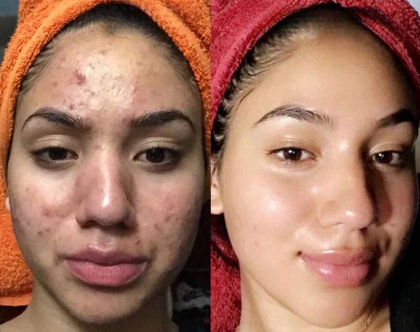 Before After Results
