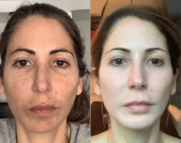 Before After Results