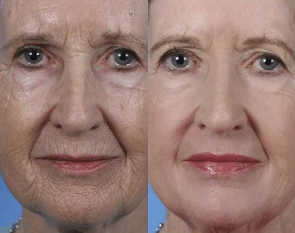 Before After Results