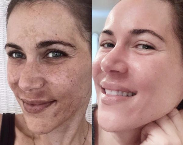 Before After Results