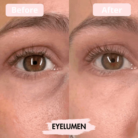 EyeLumen™ – Under-Eye Red Light Therapy Device